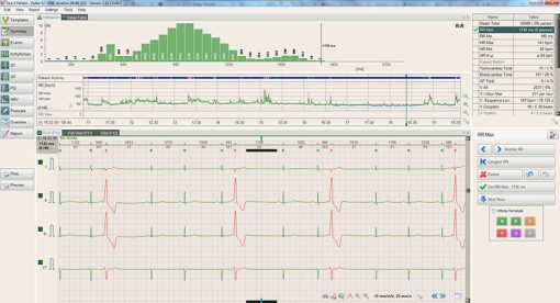 BTL_CardioPoint-Holter_Summary_view_1448292641_original